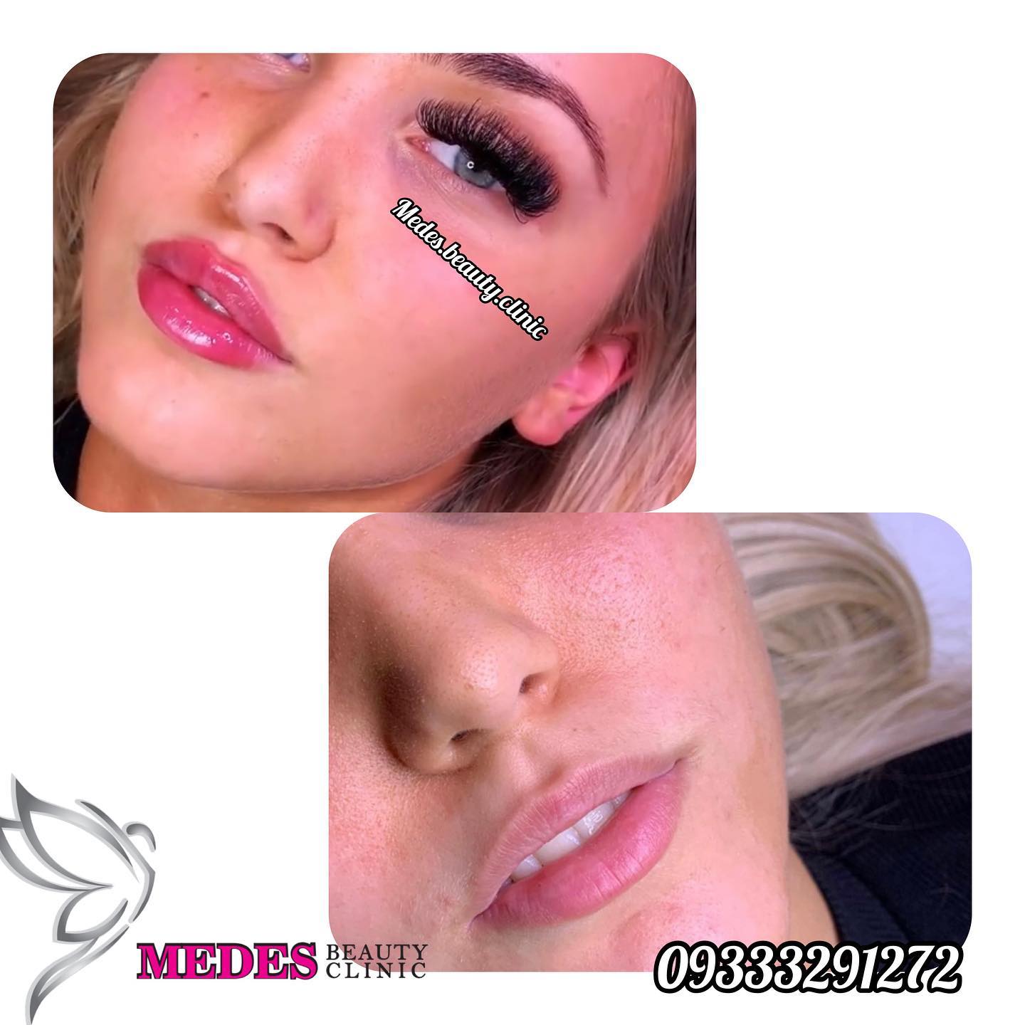 گالری تزریق ژل لب